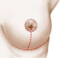 Breast Lift Perth