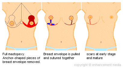 Breast-Lift-Diagram