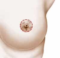 Breast Lift Perth