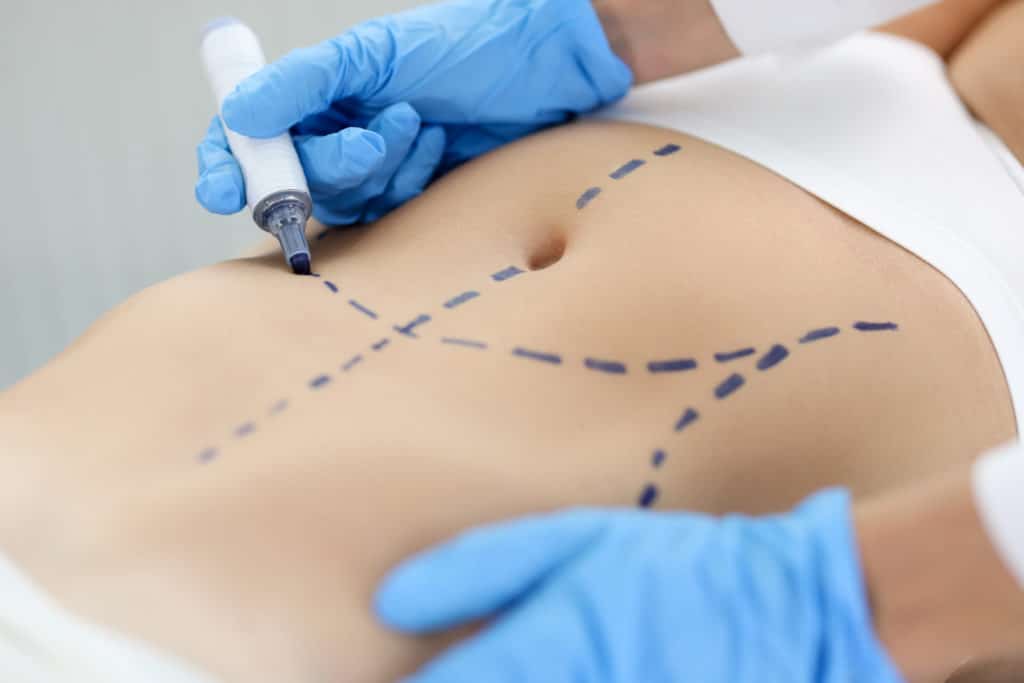 Doctor drawing preoperative marking on patient abdomen closeup