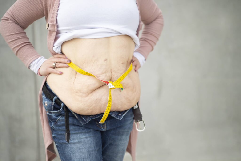 Excess skin after weight loss